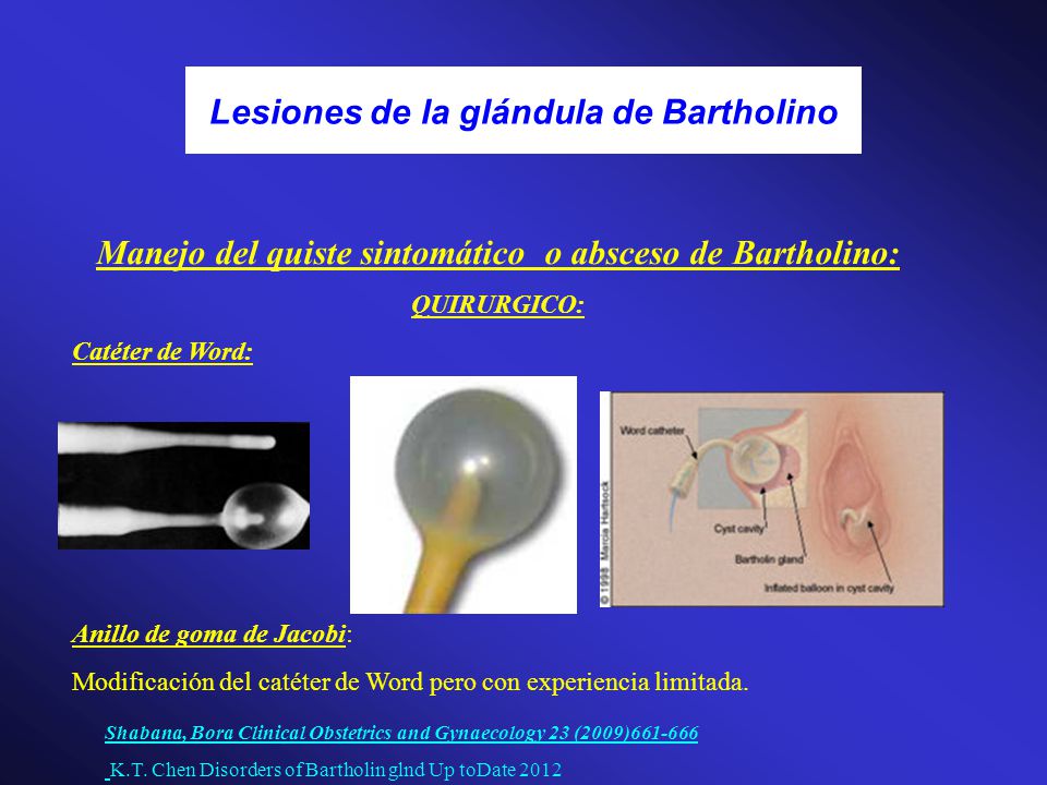 marsupializacion glandula bartolino costo marsupializacion glandula bartolino costo